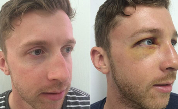 Nasal Fracture Repair