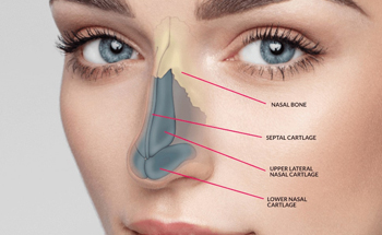 Rhinoplasty
